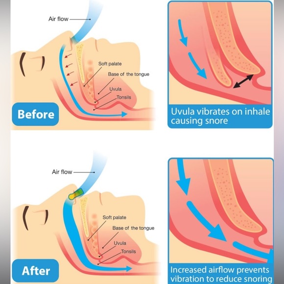 Anti Snoring Device Anti Snoring Nose Clip with  Case - Picture 9 of 10